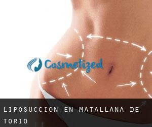 Liposucción en Matallana de Torío