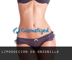 Liposucción en Onzonilla