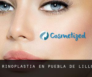 Rinoplastia en Puebla de Lillo