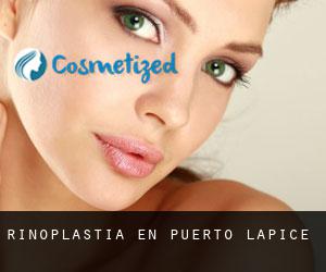 Rinoplastia en Puerto Lápice